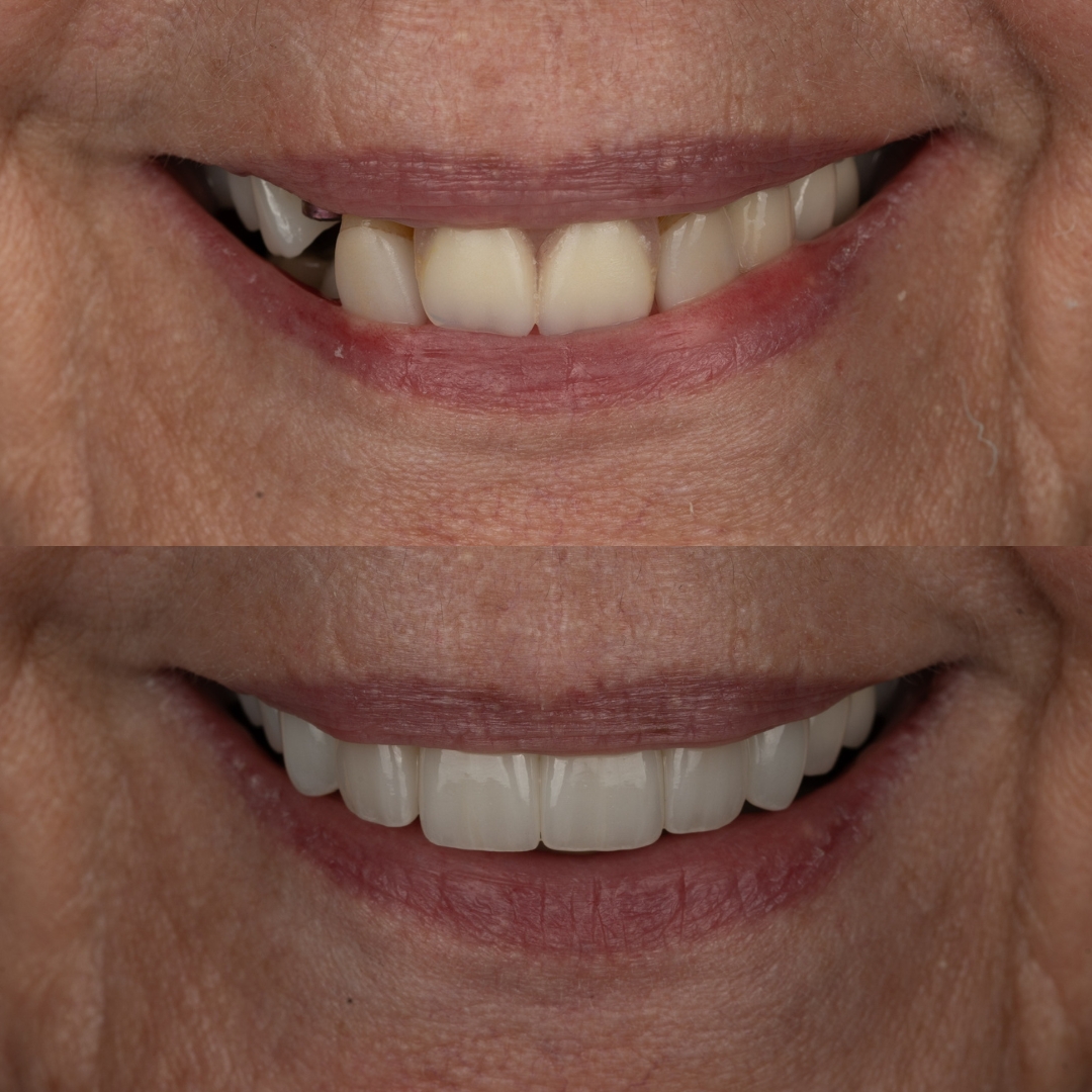 Before and after single dental implant replacing a missing tooth